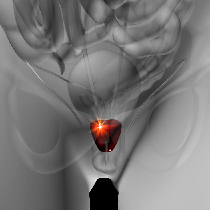 דלקת הערמונית רק הירודותרפיה (טיפול בעלוקות)!