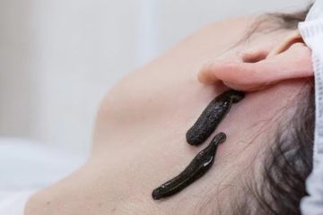 השימוש בעלוקה רפואית: היסטוריה, טיפולים ומחקרים עכשוויים
